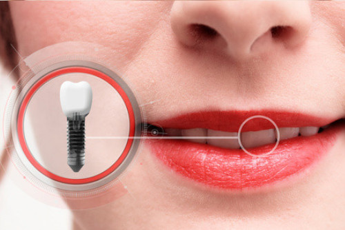 impianto dentale dentisti rimini e bologna
