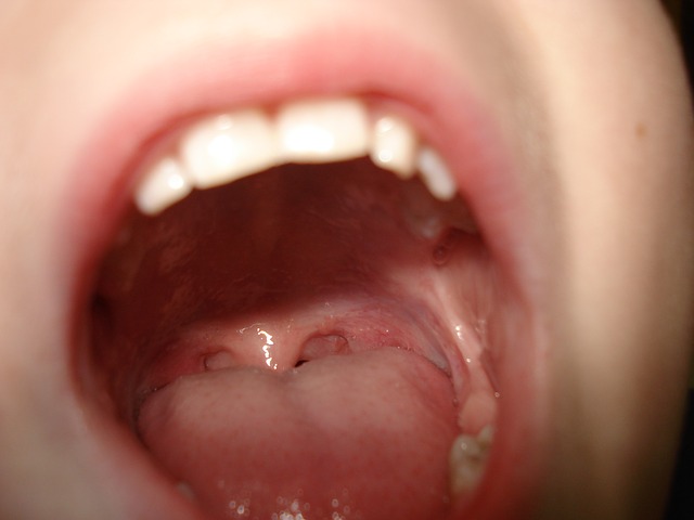 Papilloma virus sotto la lingua -