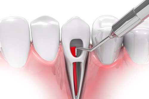 Endodonzia