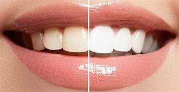 Sbiancamento Dentale: La Guida Completa per un Sorriso Perfetto e Luminoso