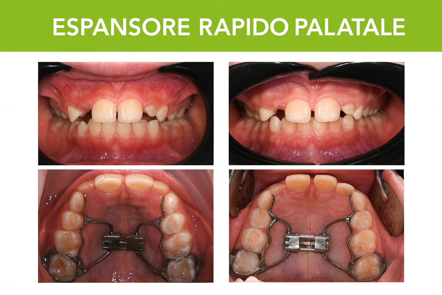 Espansore Rapido del Palato: La Soluzione per il Palato Stretto