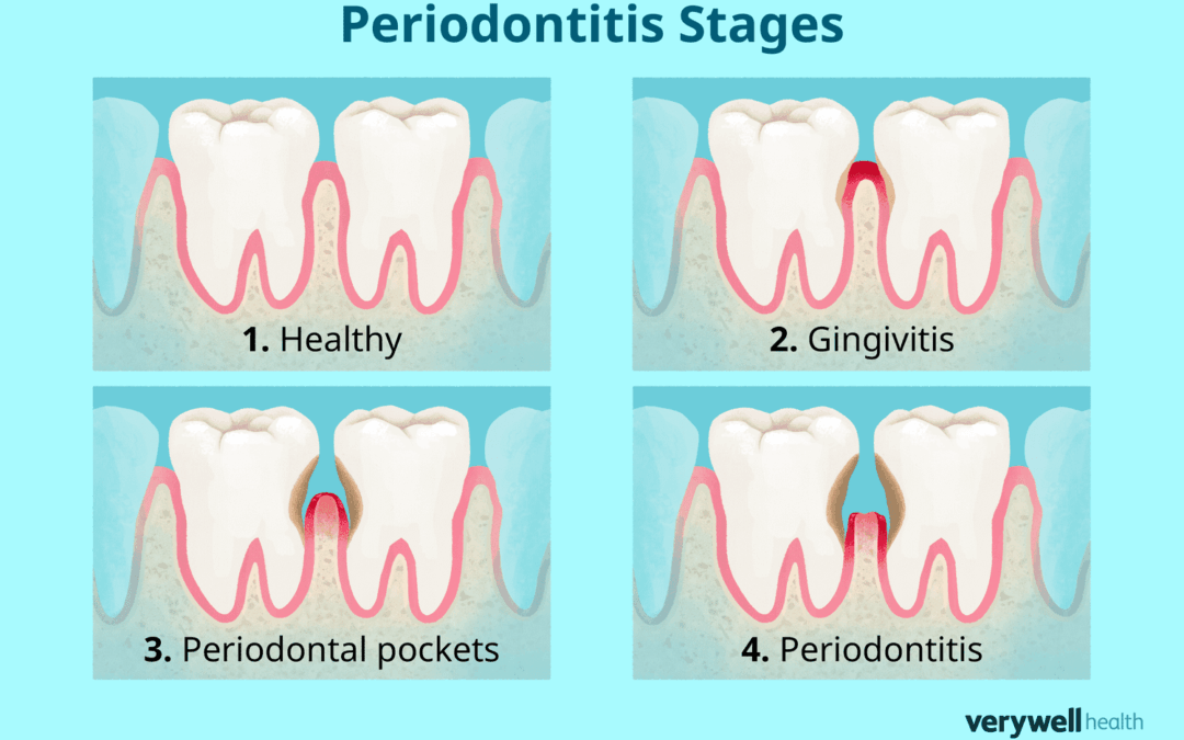 Parodontite: le fasi