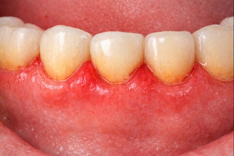 Infiammazione gengivale causata da gengivite con gengive rosse