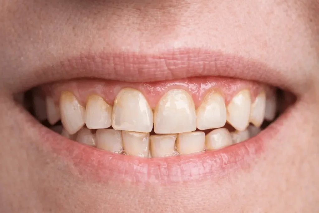 denti usurati e gengive infiammate prima del trattamento con faccette dentali