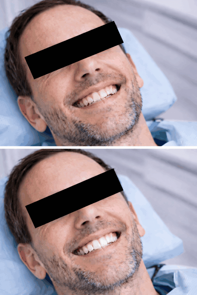 Esperienza reale faccette dentali uomo prima e dopo con paziente anonimizzato e sorriso migliorato
