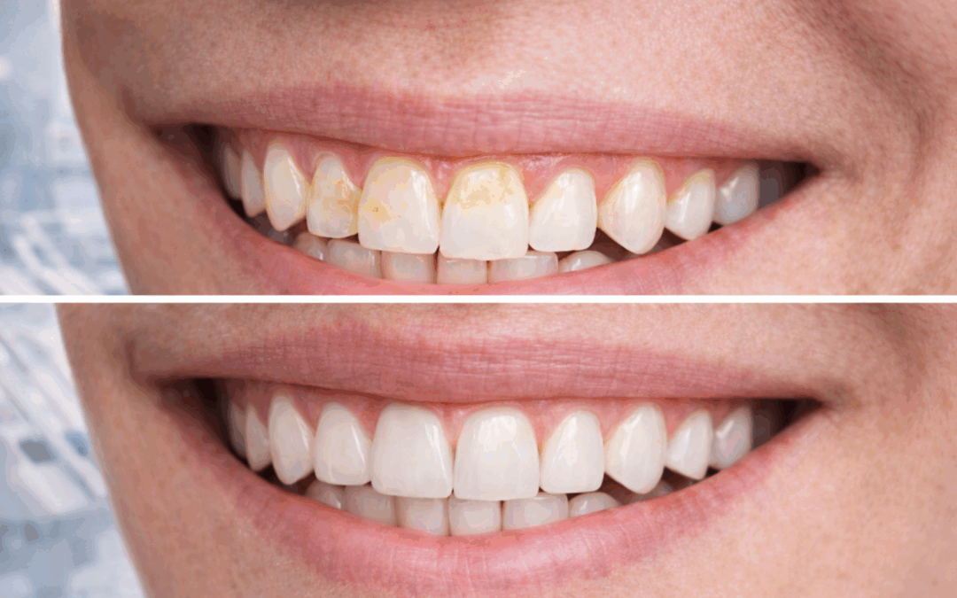 Prima e dopo faccette dentali a Rimini miglioramento sorriso naturale