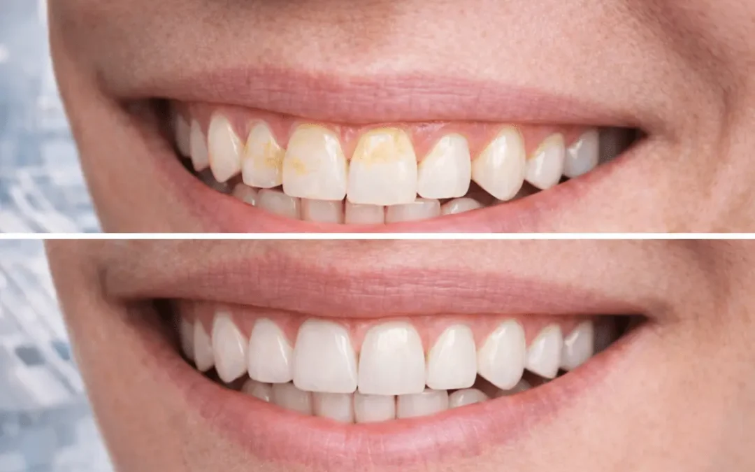 Faccette dentali a Rimini: quando servono, costi e risultati reali