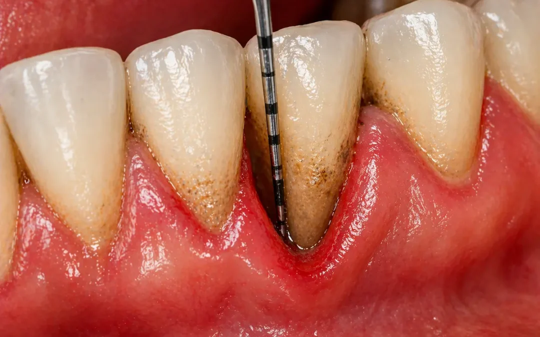 parodontite recidiva tasche gengivali