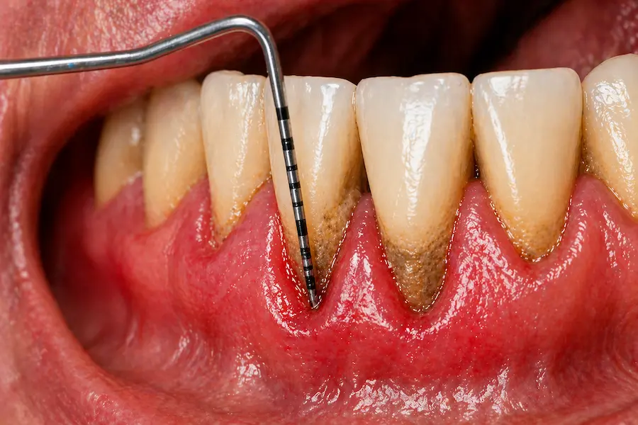 tasche gengivali parodontite recidiva