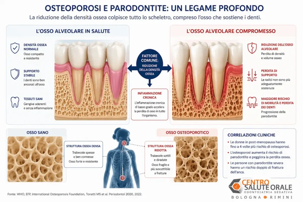 Infografica medica che illustra il legame tra osteoporosi e parodontite, confrontando un osso alveolare sano con uno compromesso e mostrando come la perdita di densità ossea aumenti il rischio di perdita del supporto dentale.