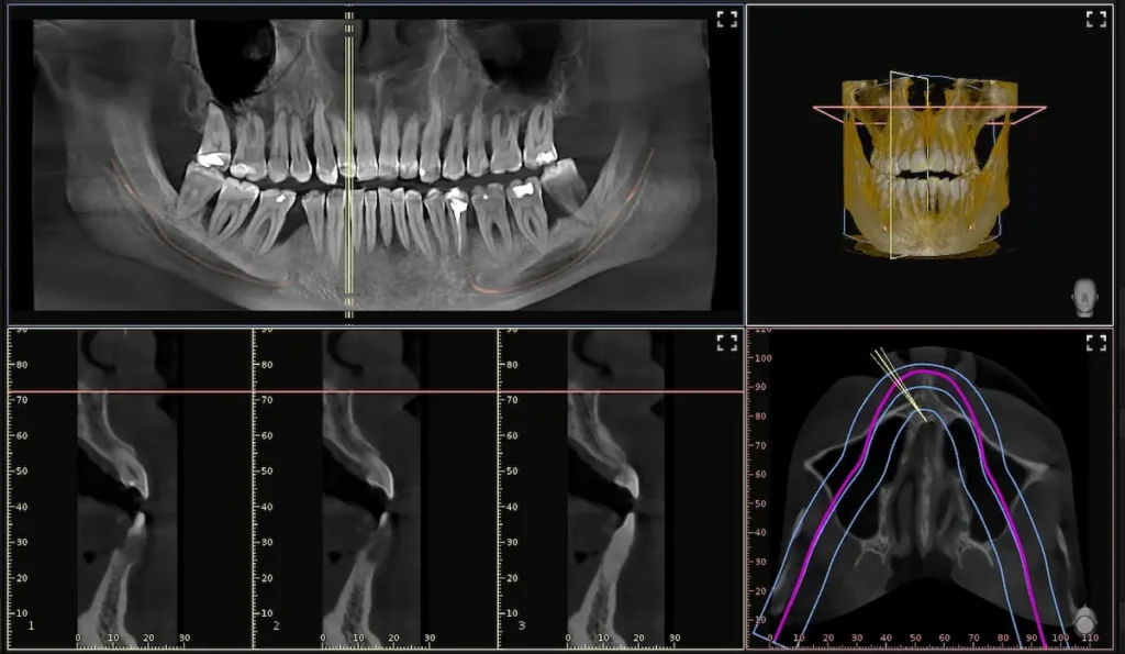 Pianificazione digitale della chirurgia parodontale mediante radiografie e CBCT.
