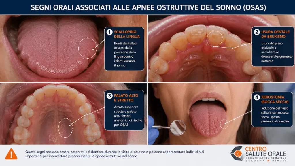 Segni clinici osservabili dal dentista nei pazienti con apnee ostruttive del sonno.