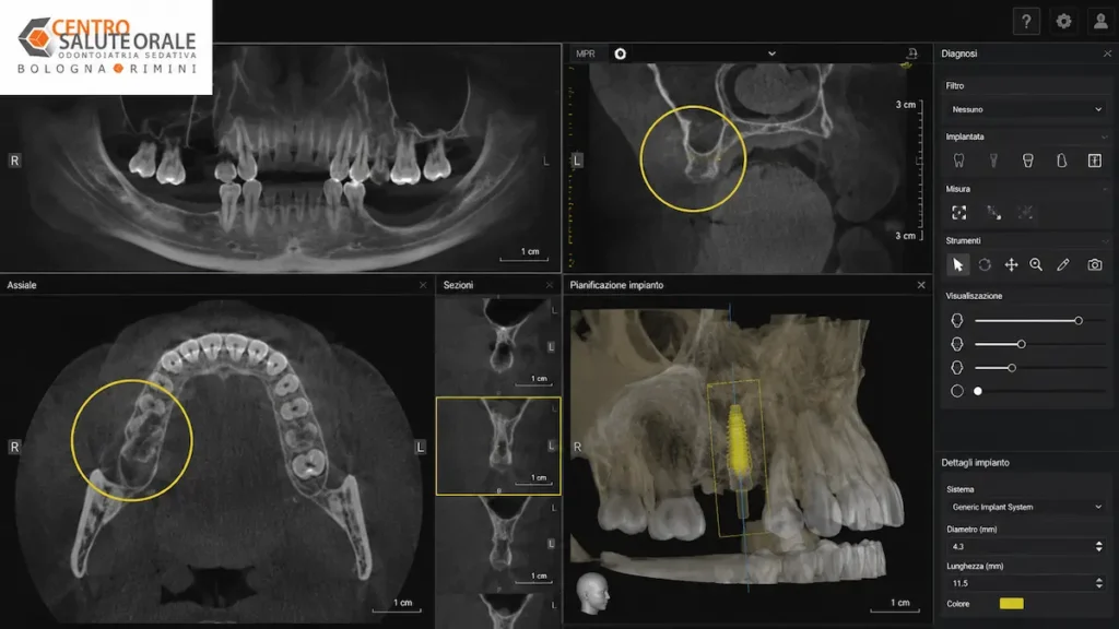TAC Cone Beam 3D con riassorbimento osseo e pianificazione digitale di un impianto dentale in un paziente con poco osso presso il Centro Salute Orale