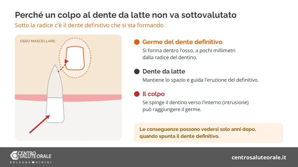 Schema del dente da latte con il germe del dente definitivo che si forma sotto la radice e la direzione del colpo